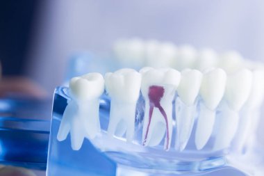 Diş diş kök modeli