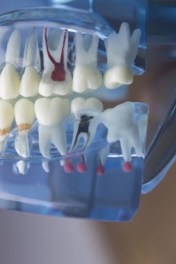 Diş diş diş hekimliği modeli