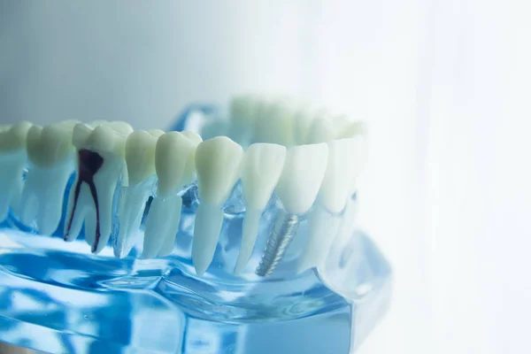 Tandheelkundige tanden tandheelkunde model — Stockfoto