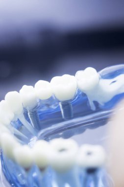 Diş diş diş hekimliği modeli