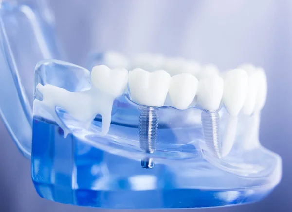 Modello di odontoiatria dentale — Foto Stock