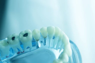 Diş diş diş hekimliği modeli