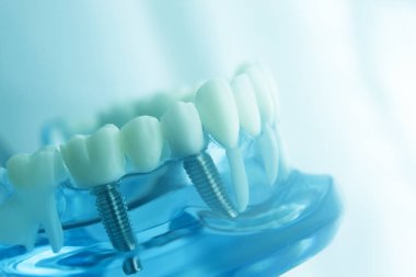 Diş diş diş hekimliği modeli