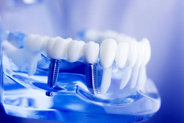 Modello di odontoiatria dentale — Foto Stock