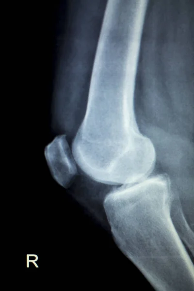 Ортопедія травма коліна Рентгенівське сканування — стокове фото