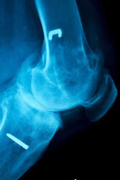 Implante ortopédico de rodilla Radiografía — Foto de Stock