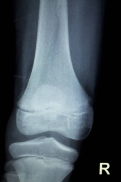 Orthopedie knie letsel Xray scan — Stockfoto