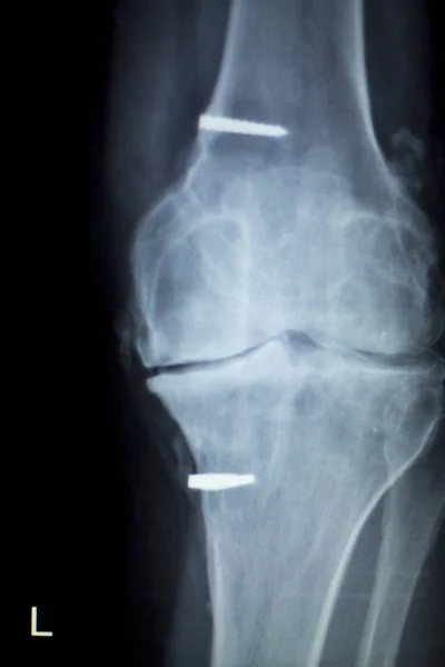 Ortopedisk knä implantat Xray scan — Stockfoto