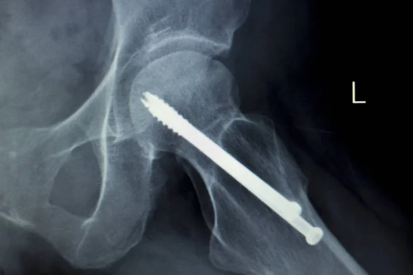Імплантація гвинта хіп-хопу Рентгенівське сканування — стокове фото