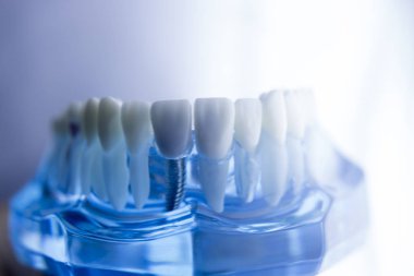 Diş diş diş hekimliği modeli