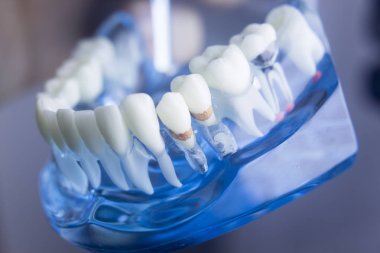 Diş diş diş hekimliği modeli