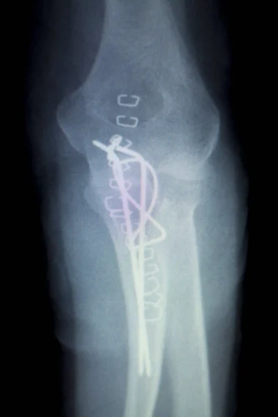 Orthopédie Lésion du genou Radiographie — Photo