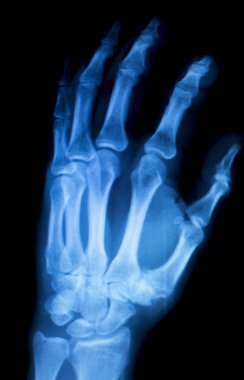 El parmakları inury Xray tarama