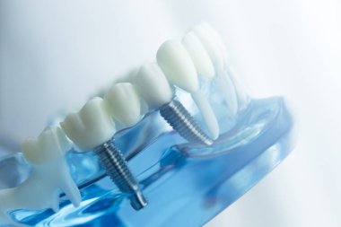 Diş diş diş hekimliği modeli