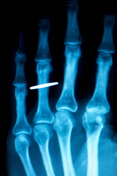 El parmaklarında Xray tarama implant — Stok fotoğraf