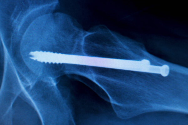 Hip screw implant Xray scan