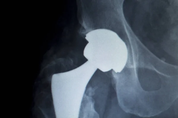 Імплантат заміни кульшового суглоба Рентгенівське сканування — стокове фото