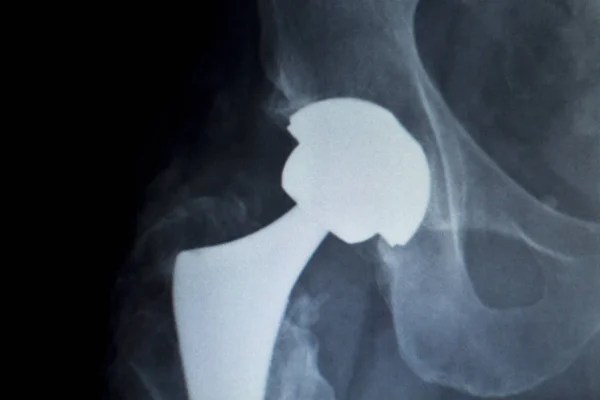 Kalça protezi implant Xray tarama