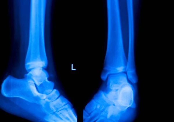 Xray foot heel ankle scan