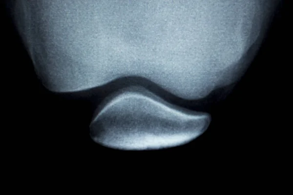 骨科膝关节损伤 x 射线扫描 — 图库照片