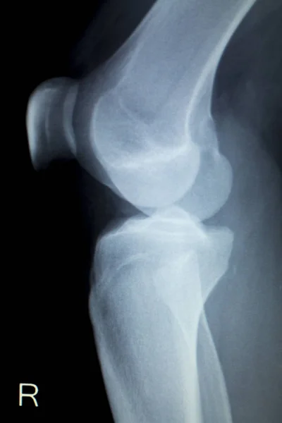 Ortopedia lesão no joelho Raio-X — Fotografia de Stock