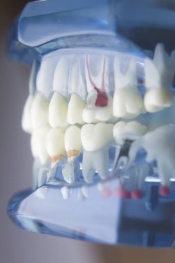 Diş diş diş hekimliği modeli
