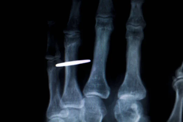 Prsty rukou implantát Xray skener — Stock fotografie