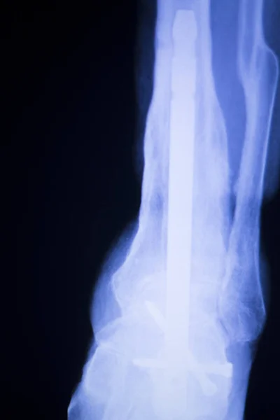 Xray tornozelo pé varredura — Fotografia de Stock