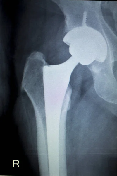 Hip replacement implant Xray scan — Stock Photo, Image