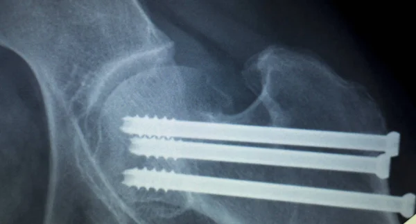 Implantu stawu biodrowego Śruba skanowania Xray — Zdjęcie stockowe