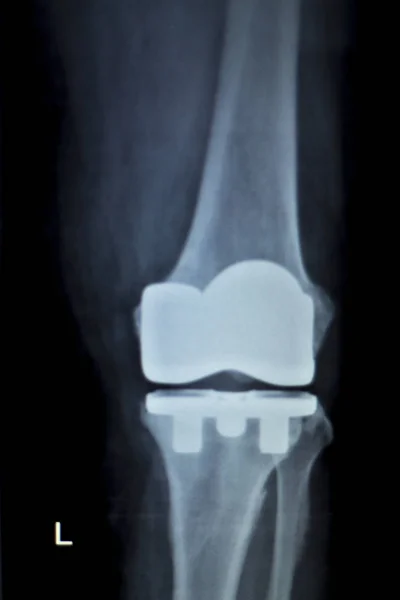 Implante ortopédico de rodilla Radiografía —  Fotos de Stock