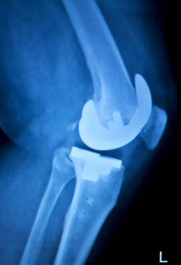 Ortopedik diz implantı Xray tarama