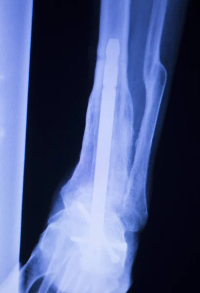 X 射线的脚踵踝关节扫描 — 图库照片