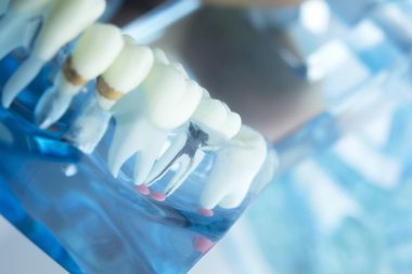 Diş diş diş hekimliği modeli