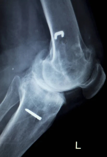 Ортопедична імплантація коліна Рентгенівське сканування — стокове фото
