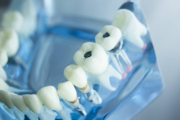 Dental teeth plaque model