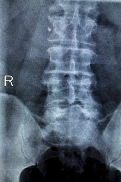 Spine hips Xray test scan — Stock Photo, Image