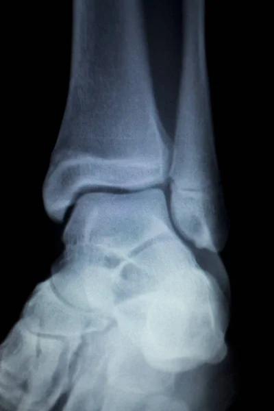 Stock image Xray foot heel ankle scan