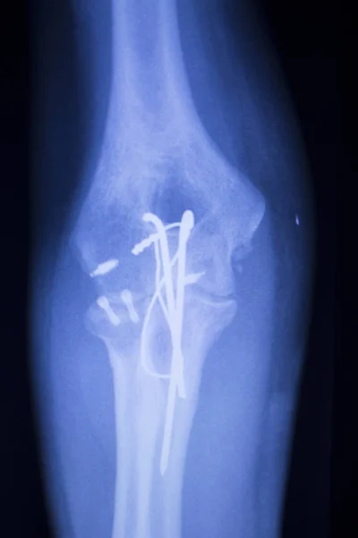 Elbow joint implant xray — Stock Photo, Image