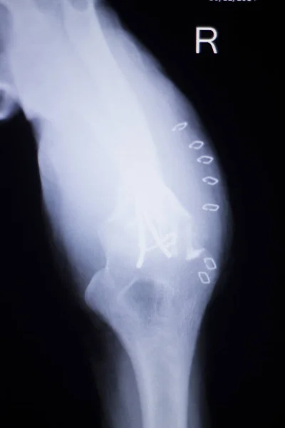 Armbågsleden implantat xray — Stockfoto