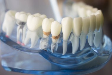 Diş diş plak modeli