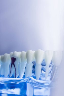 Diş diş diş hekimliği modeli