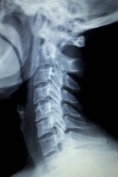 Análisis de rayos X del cuello de la columna vertebral — Foto de Stock