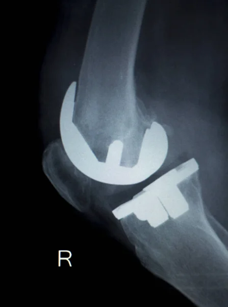 Implante ortopédico de rodilla Radiografía — Foto de Stock