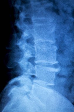 Omurga kalça Xray sınama taraması