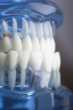 Diş diş diş hekimliği modeli