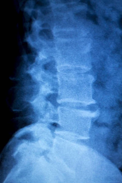 Рентген позвоночника — стоковое фото