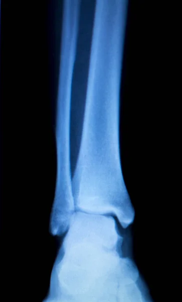 X 射线的脚踵踝关节扫描 — 图库照片