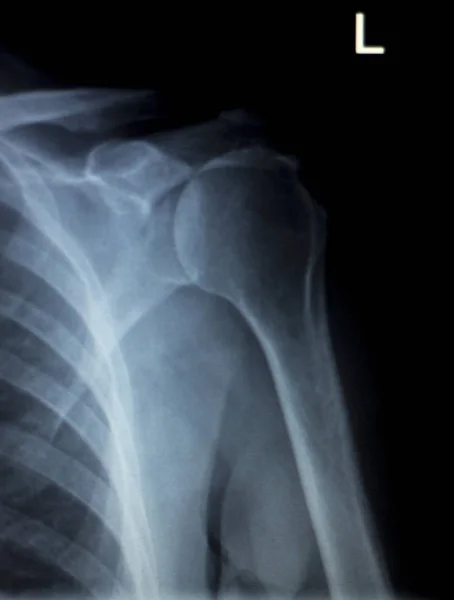 Ombro costas costelas varredura de raios X — Fotografia de Stock