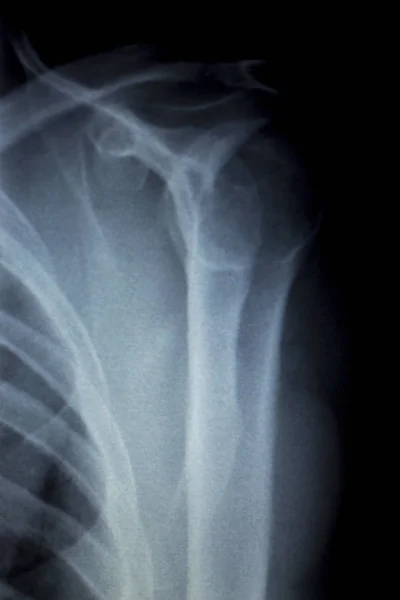Ombro costas costelas varredura de raios X — Fotografia de Stock